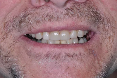 After dental treatment