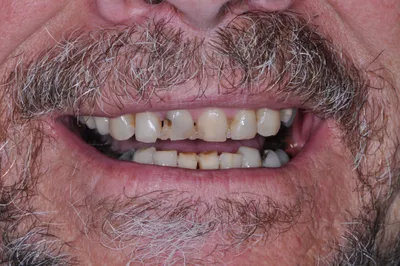 Before dental treatment