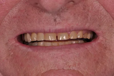 Before dental treatment