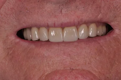 After dental treatment