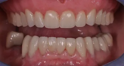 After dental treatment