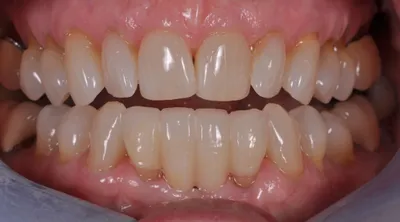 After dental treatment