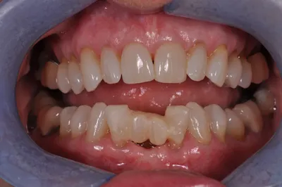 Before dental treatment