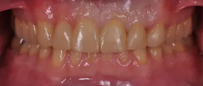 After dental treatment