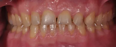 Before dental treatment