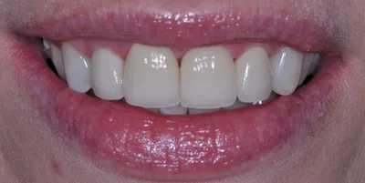 After dental treatment