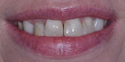 Before dental treatment