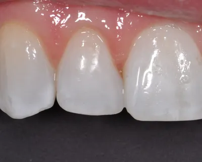 After dental treatment