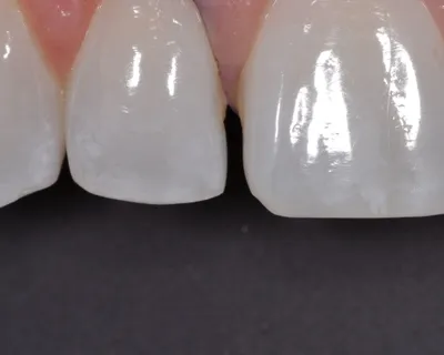 Before dental treatment