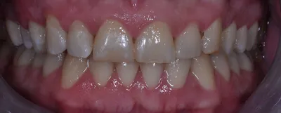 After dental treatment