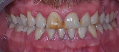 Before dental treatment