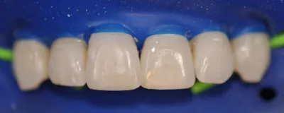 After dental treatment