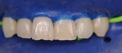 Before dental treatment