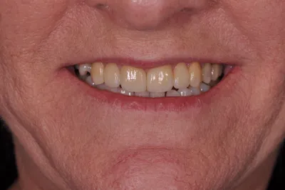 After dental treatment