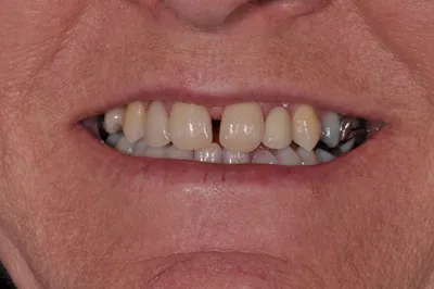 Before dental treatment