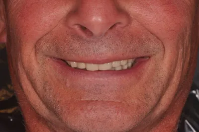 After dental treatment