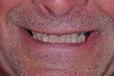 Before dental treatment