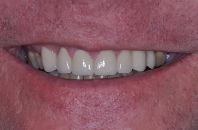 After dental treatment