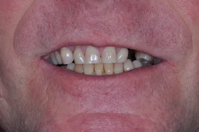 Before dental treatment