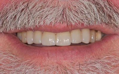 After dental treatment