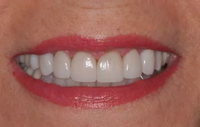 After dental treatment