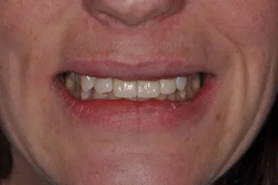 After dental treatment