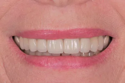 After dental treatment