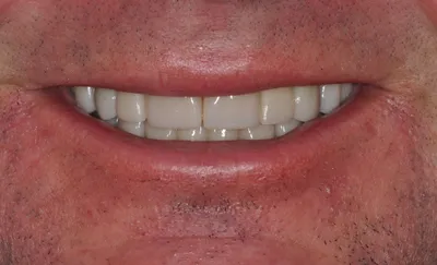 After dental treatment