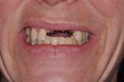 Before dental treatment