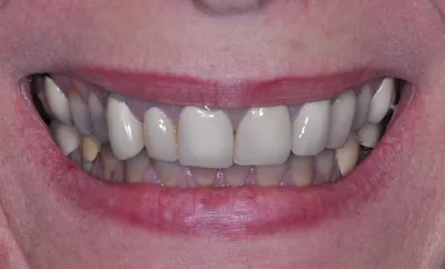 Before dental treatment