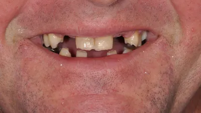 Before dental treatment